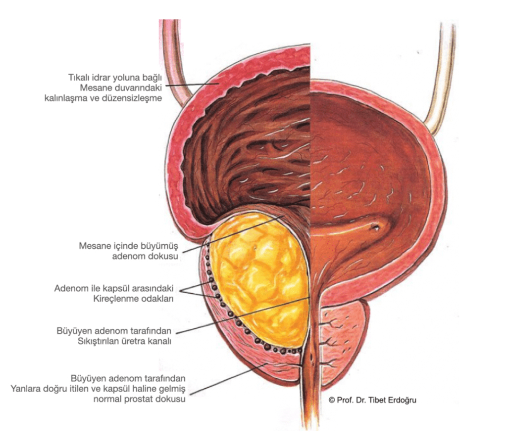 Д простату. Предстательная железа расположена. Аденома простаты анатомия. Предстательная железа анатомия расположение. Простата и предстательная железа.